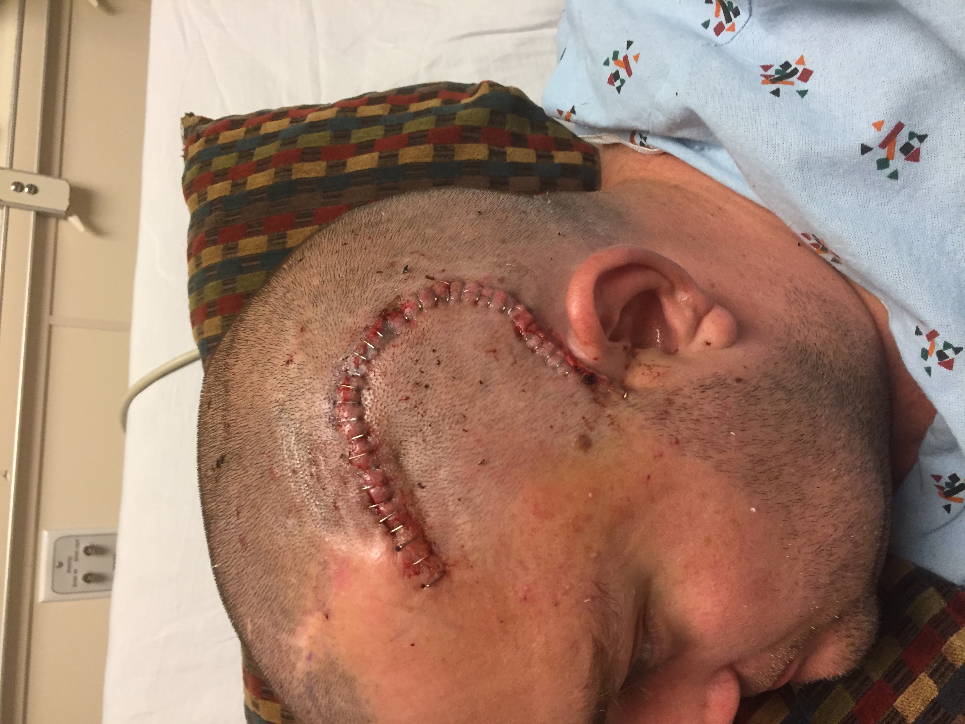 After left anterior temporal lobectomy surgery in 2017, stapled incision on the left side of the head