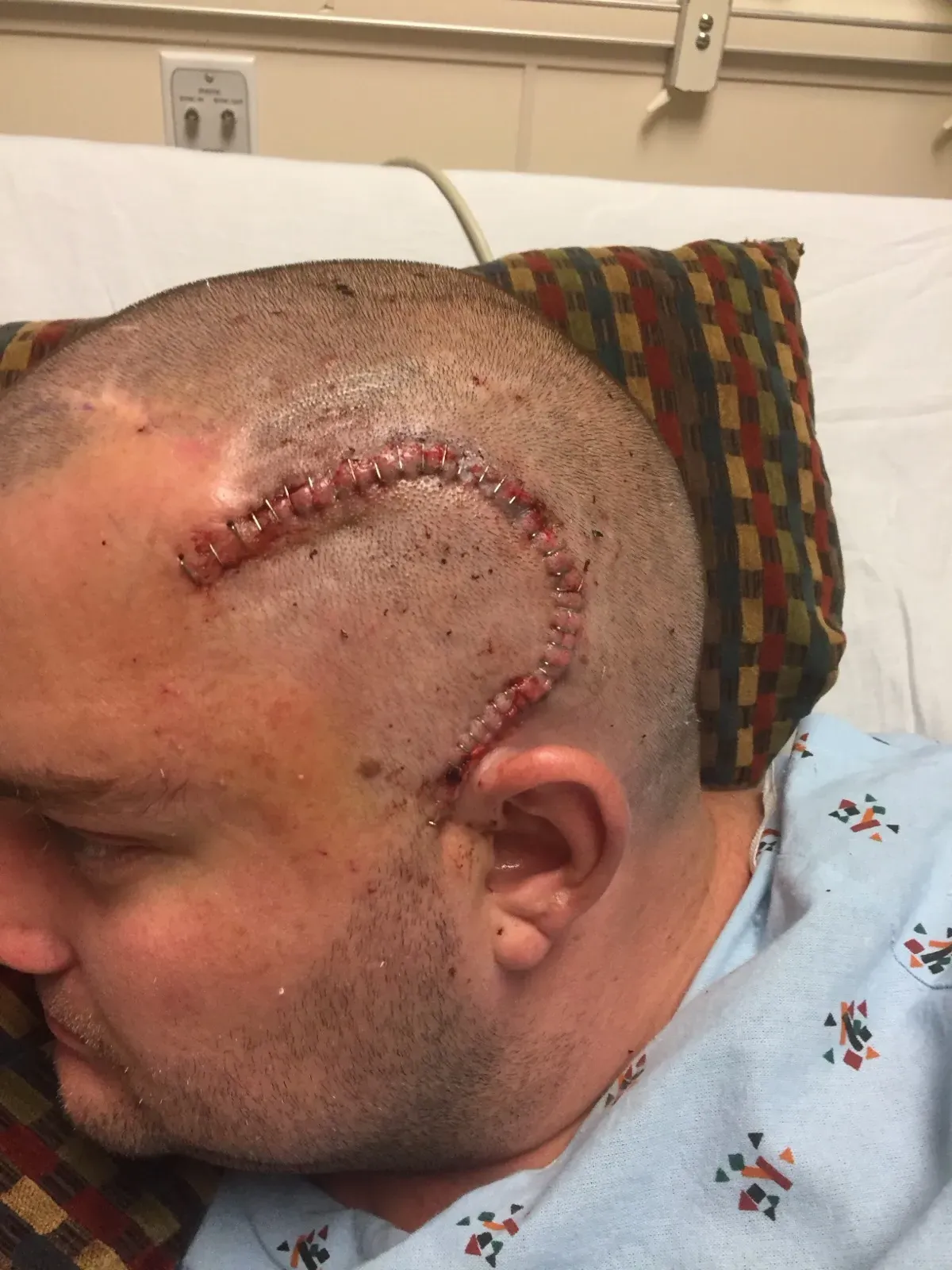 After left anterior temporal lobectomy surgery in 2017, stapled incision on the left side of the head