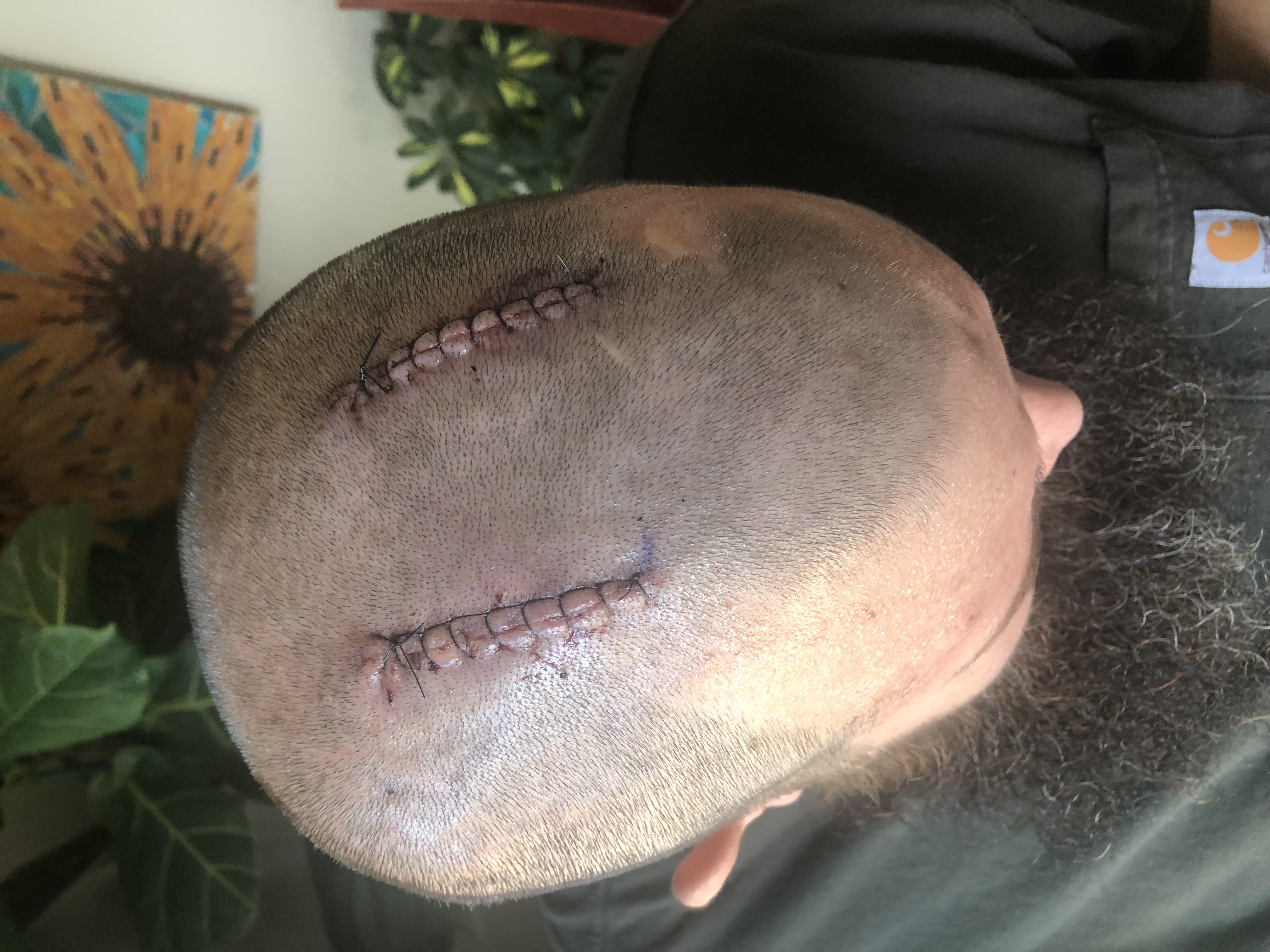 After deep brain stimulation surgery in 2022, two sutured incisions on the top of the head
