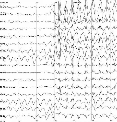 EEG spike-and-wave pattern