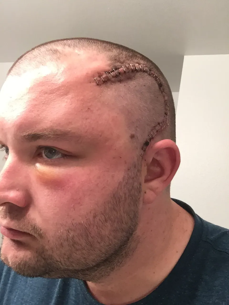 Healing incision the next day, with bruising around the eye, after left anterior temporal lobectomy surgery in 2017